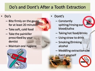 Do’s and Dont’s After a Tooth Extraction
