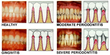periodontal_disease